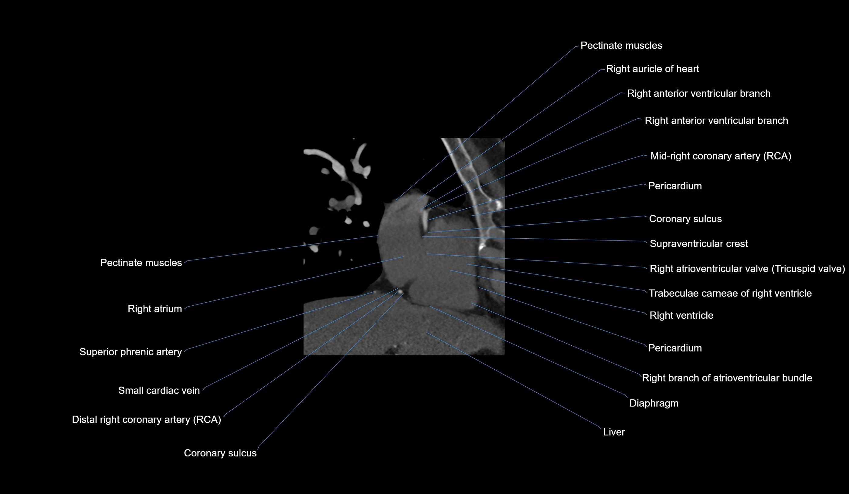 CT heart (coronary angiogram) 2 chamber view cross sectional anatomy labelled radiology image-00034.webp